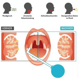 Manual Tonsil Pedra Ferramenta De Remoção, PVC Sucção Bola, Mau hálito Remoção Tubo De Vidro De Garganta, Aspirador De Boca - Image 6