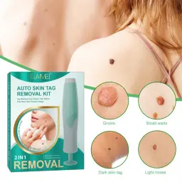 Skin Tag Removal Kit, Cotonetes de Limpeza, Dermatologista Recomendado, Seguro e Eficaz, Fácil e Indolor, Acessível - Image 1