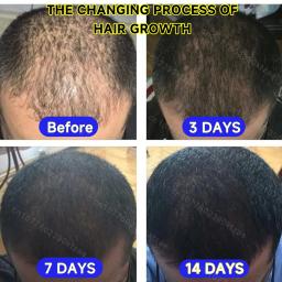 Spray de crescimento capilar para homens e mulheres, cuidados com os cabelos, couro cabeludo Nutre as raízes do cabelo, impede a perda de cabelo, planta natural, crescimento rápido - Image 5