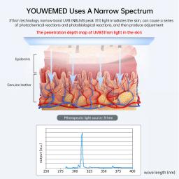 YOUWEMED-Ultravioleta Fototerapia Instrumento, Use UVB Lâmpada, UV para Vitiligo, Psoríase, manchas brancas, doença de pele, 311nm - Image 4