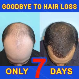 Produtos rápidos do crescimento do cabelo, cuidado capilar, reparo, perda do Anti-cabelo - Image 1