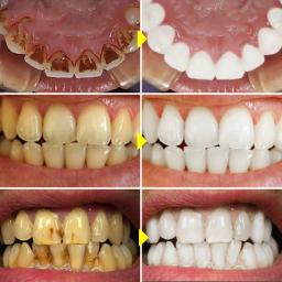 V34 clareamento dos dentes enzima pasta de dentes remover manchas de placa mousse limpeza higiene oral ferramentas dentárias respiração fresca beleza saúde - Image 2