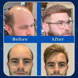 Produtos rápidos do crescimento do cabelo, cuidado capilar, reparo, perda do Anti-cabelo - Image 2