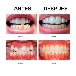 Dispositivo ortodôntico dental transparente, protetor bucal, protetor, dentário, correção de sorriso, macio e duro, 3 estágios - Image 3